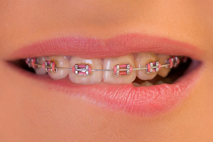 Teeth Braces